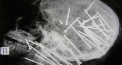 مسامير داخل جمجمة شخص 