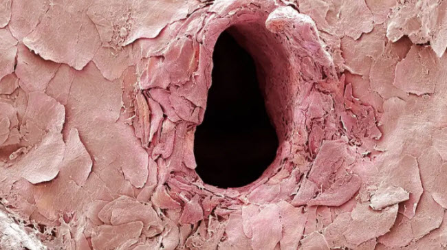 ثقب قامت به ابرة على الجلد مكبرة بميكروسكوب اليكترونى