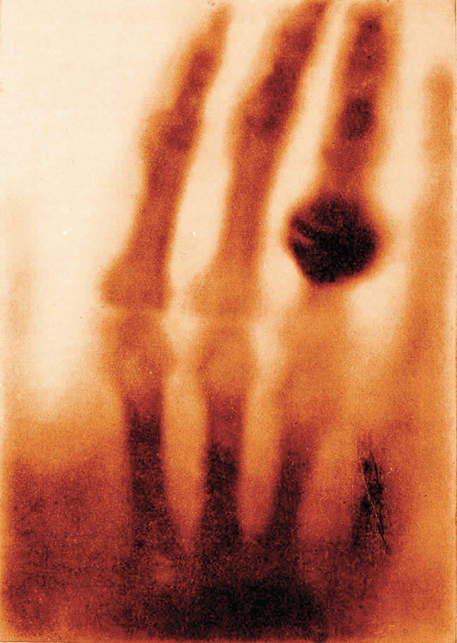 صورة اليد اليسري لزوجة العالم رونتجن التى تعتبر هى الأولي من نوعها تاريخيا التى يتم إلتقاطها من خلال الأشعة السينية