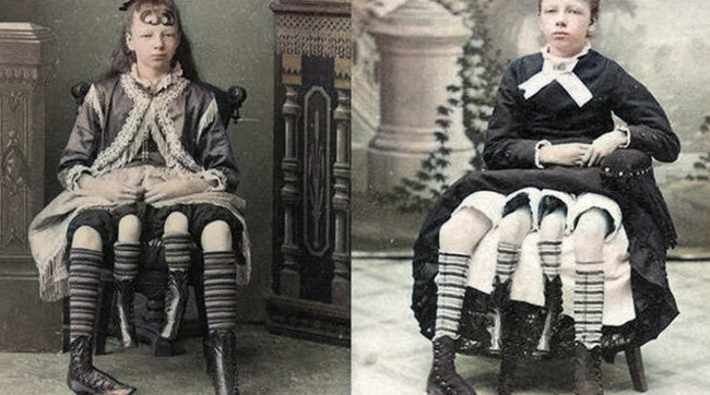 ميرتل كوربين فتاة تكساس ذات الأربعة أرجل